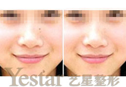 彩光嫩肤有哪些美容作用