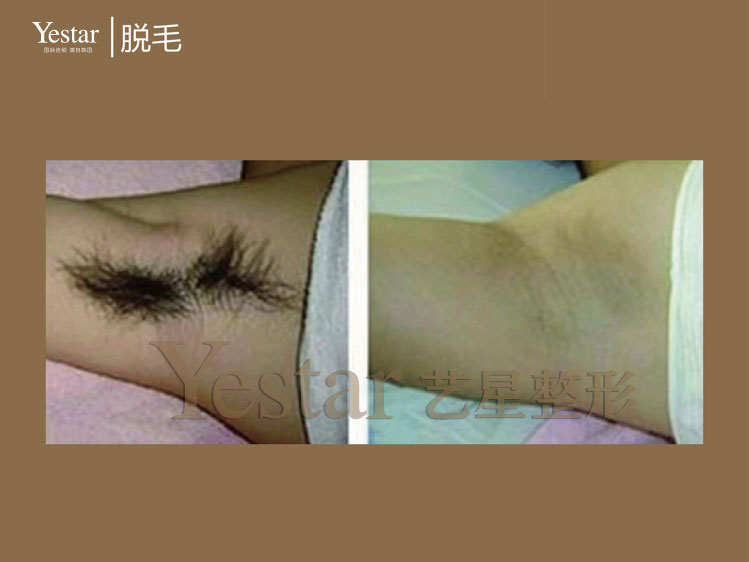长沙全身脱毛哪家医院