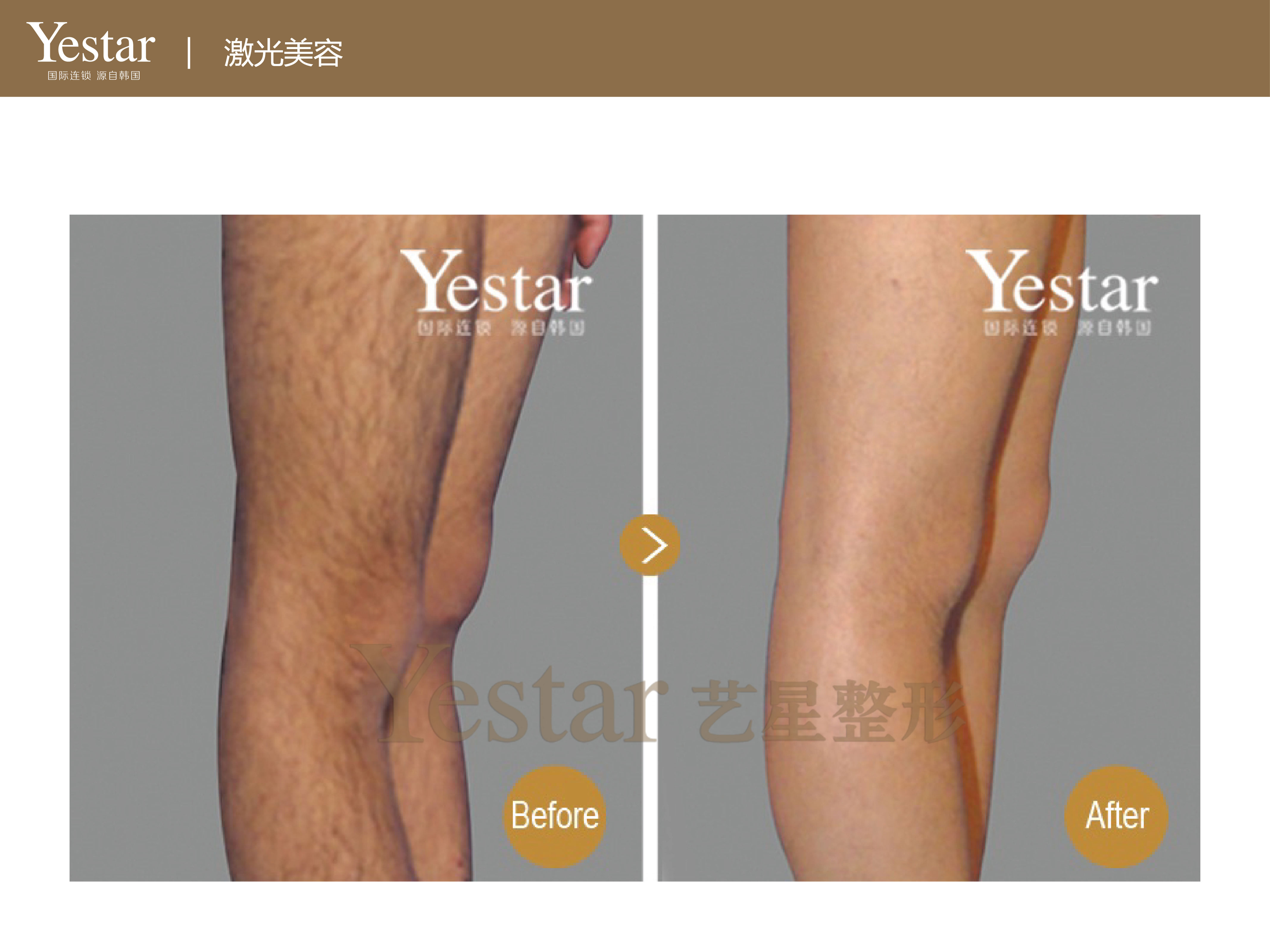 选择激光脱毛的好处有哪些