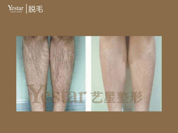 长沙小腿脱毛的价格