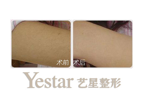 长沙激光脱毛