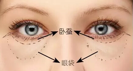 卧蚕眼袋