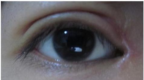 做失败眼袋修复术要注意哪些事项
