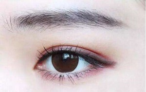 长沙双眼皮手术