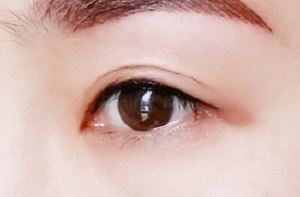长沙双眼皮手术